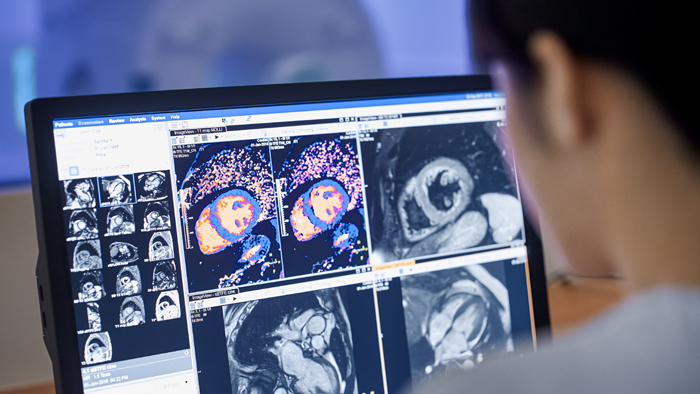 CMR with Compressed SENSE at Nottingham University Hospitals