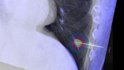 Visualize tumors and feeders with multiphase XperCT