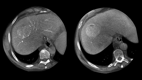 Visualize tumors and feeders with multiphase XperCT