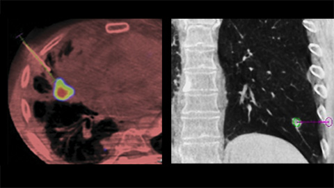 Optimal needle path planning