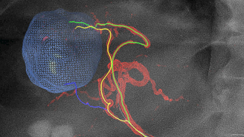 Visualize tumors and feeders with multiphase XperCT