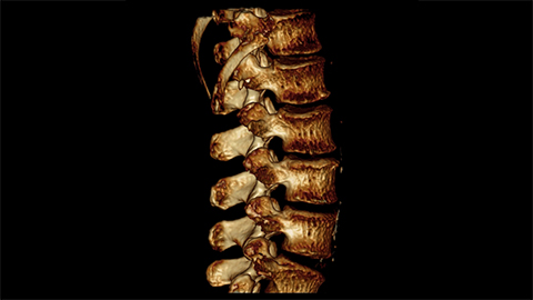 Philips Spine suite