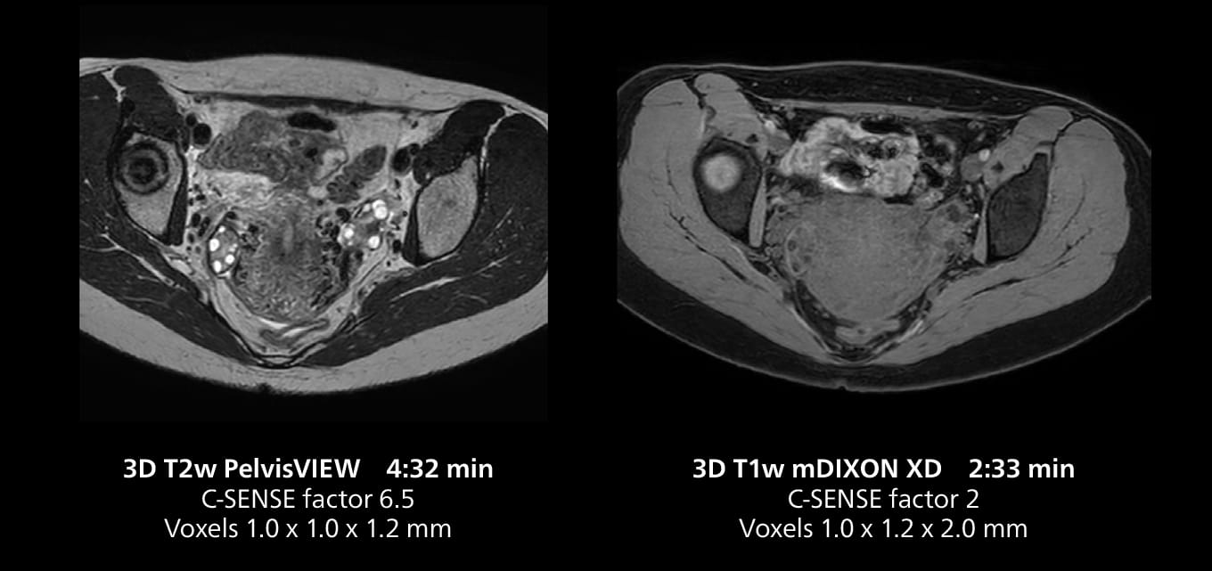 Pelvis mri one