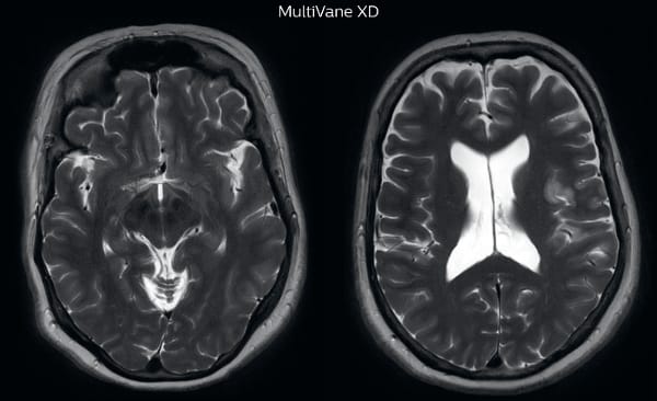 UVM case 2 motion artifact MultivaneXD