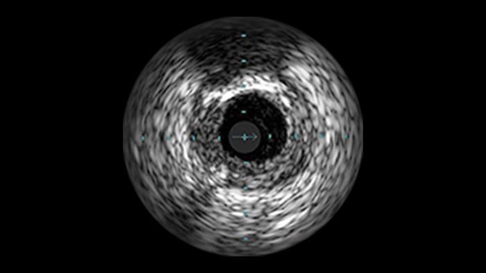 Calcified Lesions